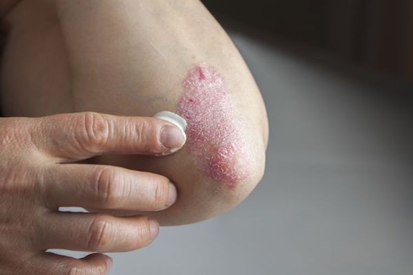 july 31st, 2015 related 银屑病是由免疫系统反应过度和创造新皮肤