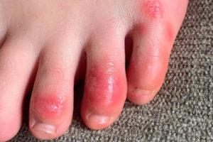 coronavirus toes covid 19